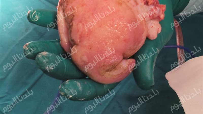 بعد الاستئصال
