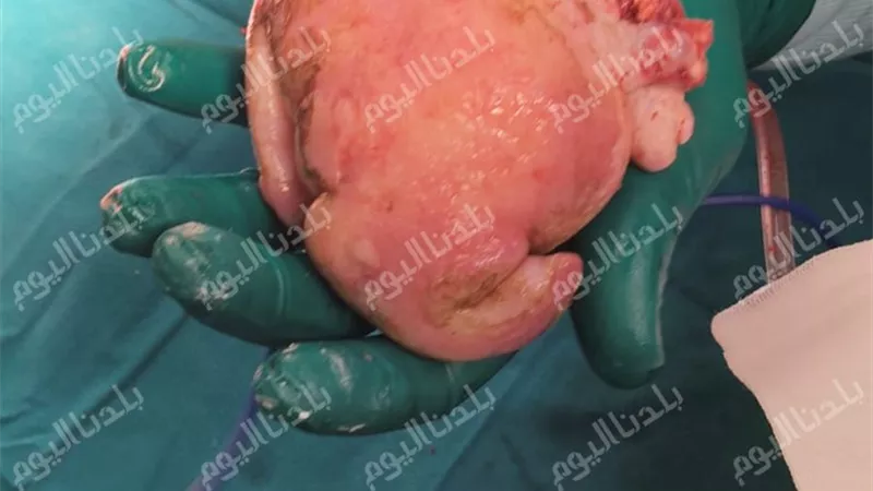 جنين داخل جنين.. حالة طبية نادرة تحوّلت إلى معركة دقيقة لإنقاذ طفلة بمعهد الكبد القومي بالمنوفية