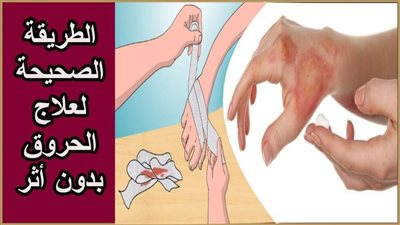 بعد حادث رمسيس.. وصفات فورية لعلاج جميع درجات الحروق