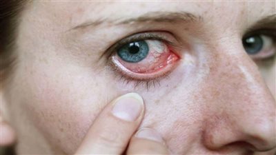 عدسات لاصقة لعلاج حساسية العين