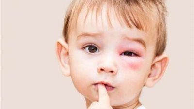 خطوات بسيطة لعلاج لدغات الحشرات في العين