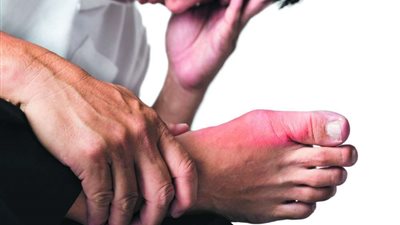 تعرف على.. علاجات منزلية للتخلص من النقرس وإلتهابات المفاصل