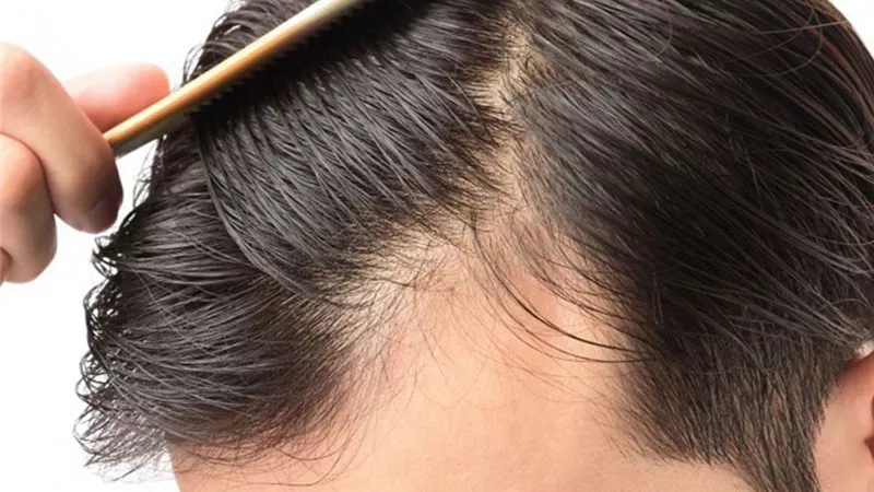 لاستعادة مظهرك وأناقتك.. 6 أطعمة تحميك من تساقط الشعر