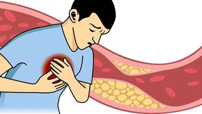 بدون عقاقير.. 5 طرق آمنه للتخلص من الكوليتسرول الضار