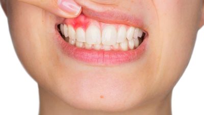 دراسة  تكشف عن مخاطر التهابات اللثة على صحة الدماغ