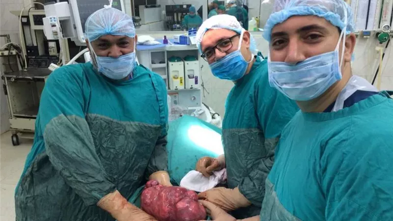 استئصال ورم يزن 40 كيلو من سيدة بطنطا