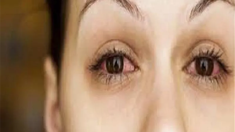 5 نصائح تخلصك من احمرار العين بعد السباحة