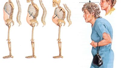 للنساء.. 5 نصائح للحماية من هشاشة العظام