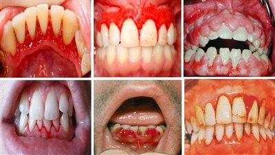 استشاري يوضح أسباب وعلاج أمراض اللثة المختلفة