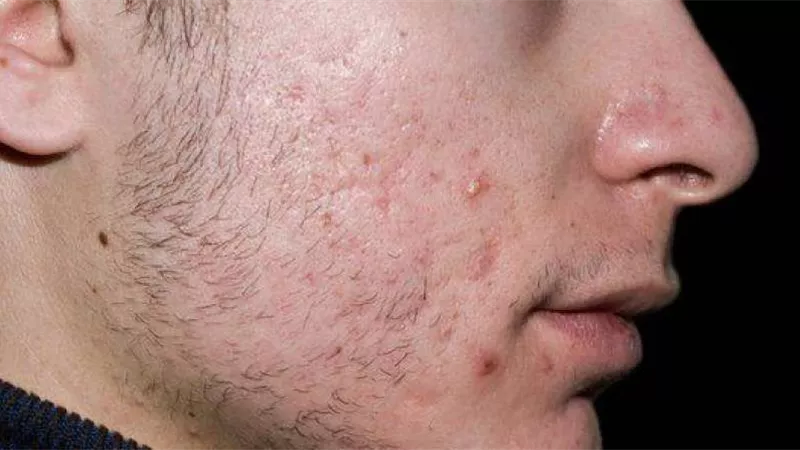 طبيب تجميل يوضح أنواع التقشير الكيميائي لإزالة ندوب الوجه