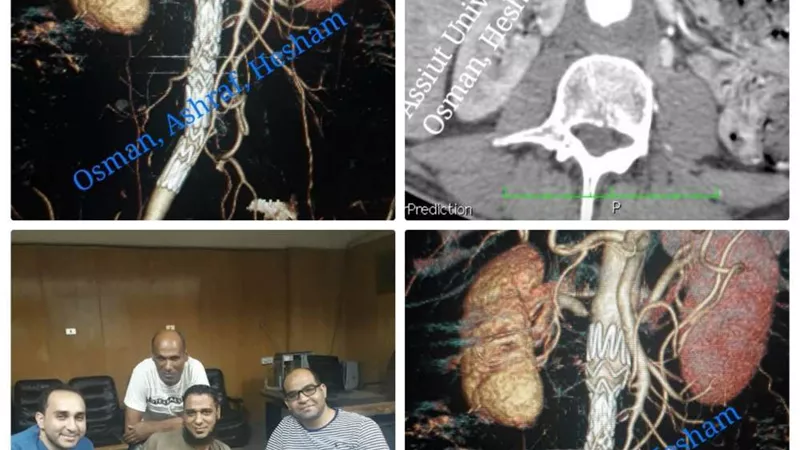 مستشفى جامعة أسيوط تُنقذ حياة شاب يعاني من تمددات الشريان الأورطي البطني