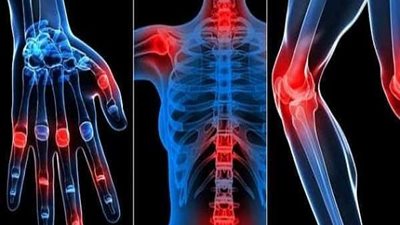 مفاجأة.. دواء معروف يقلل من خطر الوفاة بكورونا