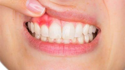 تخلص من آلامها المزعجة.. كيف تقضي على التهاب اللثة بطرق طبيعية
