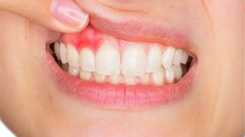 تخلص من آلامها المزعجة.. كيف تقضي على التهاب اللثة بطرق طبيعية