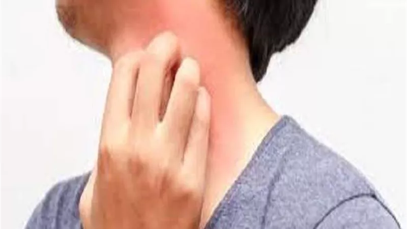 تفشى في تركيا.. أعراض الجرب وكيفية الوقاية منه