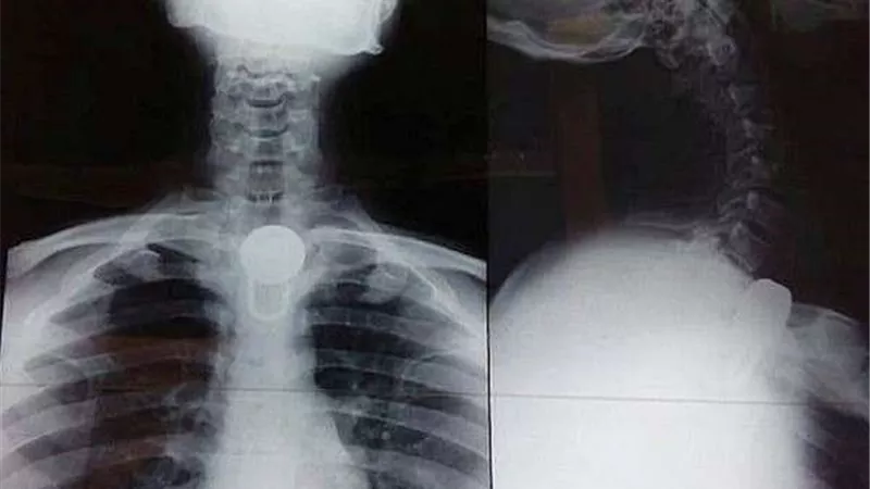 كاد أن يفقد حياته.. عشريني يبتلع 