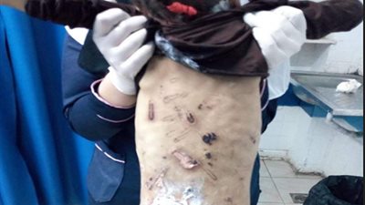 حرقتها بالمعقلة وكسرت رجلها.. تفاصيل تعذيب 