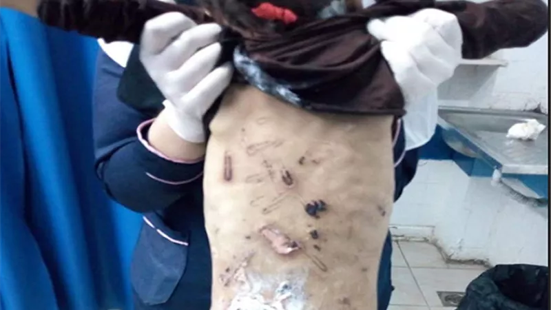 حرقتها بالمعقلة وكسرت رجلها.. تفاصيل تعذيب 