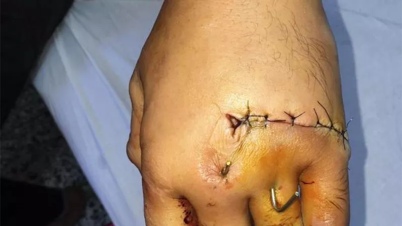 إعادة توصيل كف يد بعد بترها بمستشفى طوارئ المنصورة