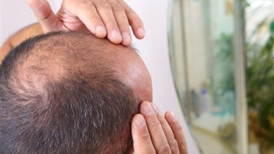 دراسة جديدة تتوصل لعلاج محتمل للصلع.. تفاصيل