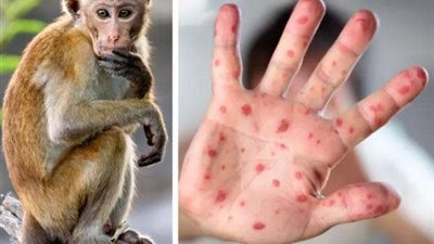 ينتقل باللمس.. تفاصيل الحالة الصحية لأول مصرى مصاب بجدرى القرود