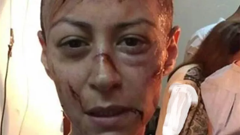 بشعر أصلع وكدمات تملأ الوجه.. هكذا أفزعت منه شلبي جمهورها