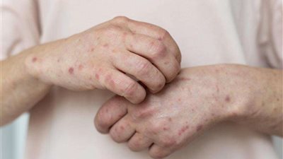 أحدهما وافد.. رئيس الطب الوقائي: لدينا حالتان من جدري القرود
