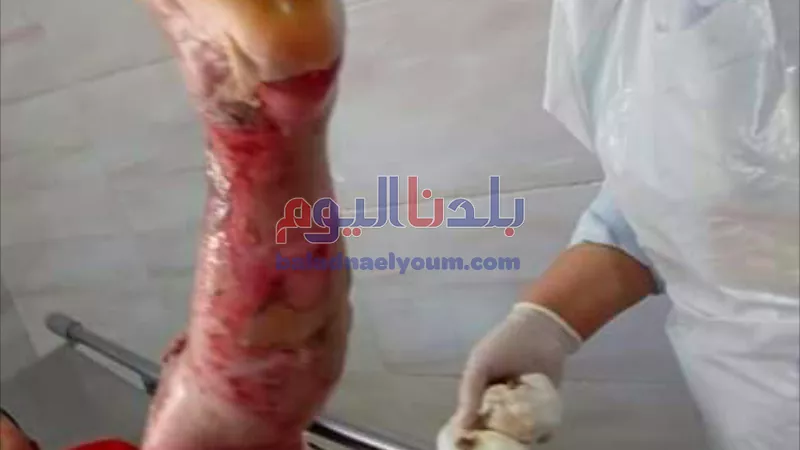 إصابة طفل بحروق إثر قيام 3 شباب بإشعال النيران في جسده بالمحلة