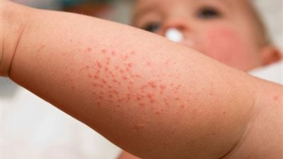 مرض خطير يصيب الأطفال تحت الـ5 سنوات.. أعراضه وكيفية الوقاية منه