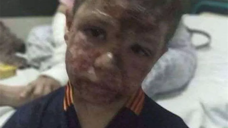 تفاصيل الحالة الصحية للمصابين التسعة في حادث إلقاء مياه نار بحفل زفاف بشبرا
