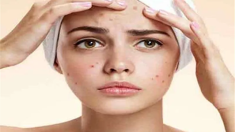 بهذه الحيلة..تخلصي من حب الشباب نهائيا بعشبة سحرية ذات تأثير فعال
