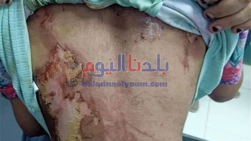 النائب العام يأمر بحبس المتهم بتعذيب الطفلة 