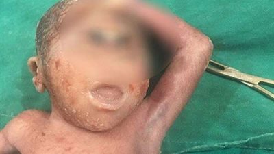 ولادة نادرة لطفل بعين واحدة بالأقصر