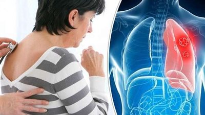 احذر.. هذا الفيتامين يمكن أن يدمر خلايا سرطان الرئة!