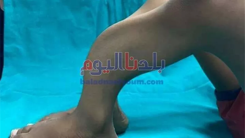 اصلاح أعوجاج فى الطرفين السفليين لطفل بالغربية