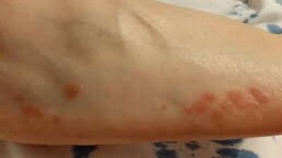 طبيبة تكشف أعراض مرض الحزام الناري وكيفية علاجه