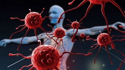 ما علاقة الإجازة بالإصابة بمرض السرطان؟.. استشاري صحة نفسية يوضح