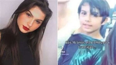 لأول مرة في العالم.. توأم يجري عملية تغيير الجنس في نفس الوقت