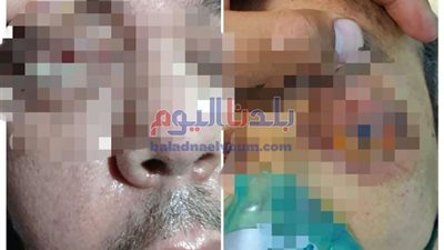 التفاصيل الكاملة عن حالتين الإصابة بالفطر الأسود بالغربية.. والصحة ترد (صور)