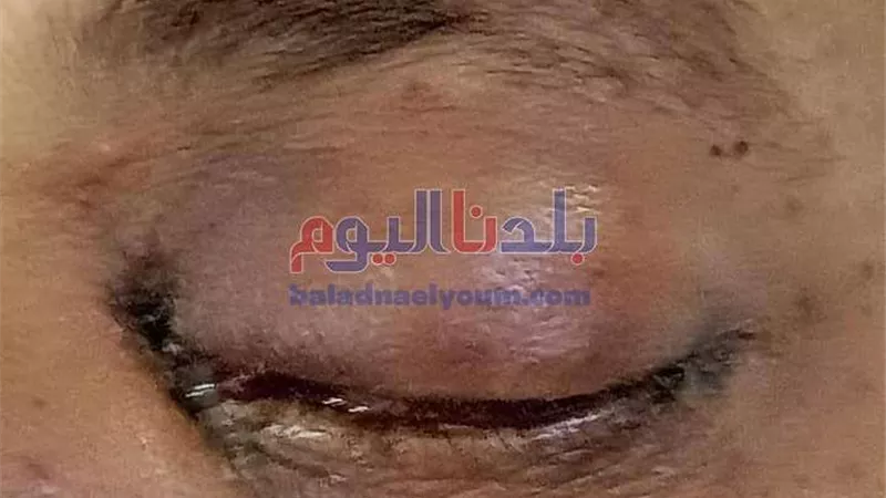 مفاجأة صادمة..  ظهور أول إصابة بالفطر الأسود بالغربية