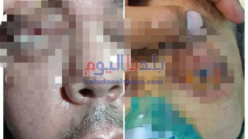 التفاصيل الكاملة عن حالتين الإصابة بالفطر الأسود بالغربية.. والصحة ترد (صور)
