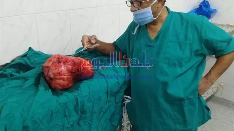 استئصال 27 ورم ليفى من رحم فتاة فى دسوق بكفر الشيخ