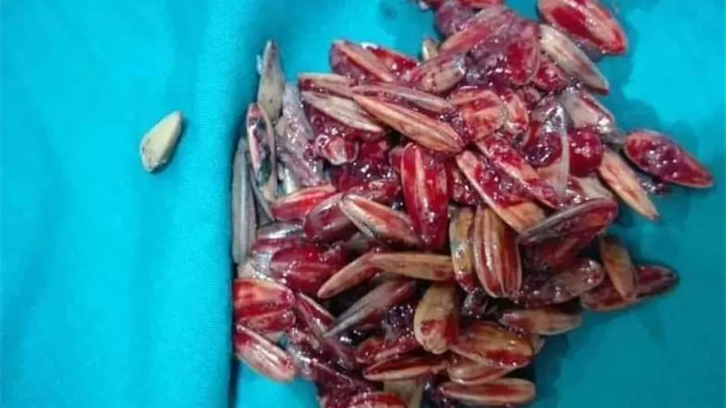 طفل ينجو من الموت بطريقة عجيبة بعد ابتلاعه لكمية كبيرة من قشر اللب السوري