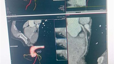 لأول مرة بالمنوفية.. نجاح أول أشعة مقطعية متعددة المقاطع ( صور )