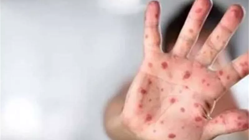 «المنوفية» تُعلن النصر على الجدري المائي وانتظام تام في الدراسة