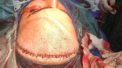 18 جراحة معقّدة للوجه والفكين و131 حالة أطفال تحت التخدير العام بصحة المنوفية 