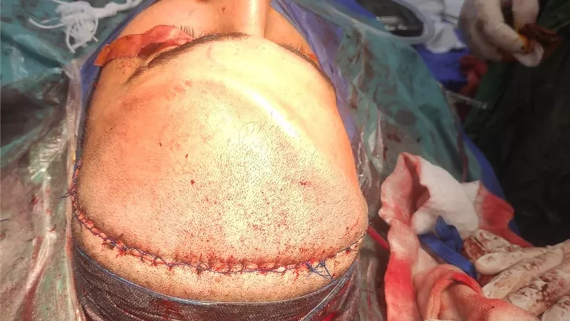 18 جراحة معقّدة للوجه والفكين و131 حالة أطفال تحت التخدير العام بصحة المنوفية 