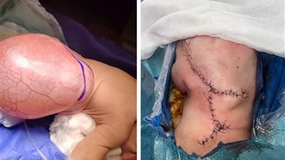 فريق طبي بجامعة أسيوط ينجح  في إجراء جراحة دقيقة لاستئصال 