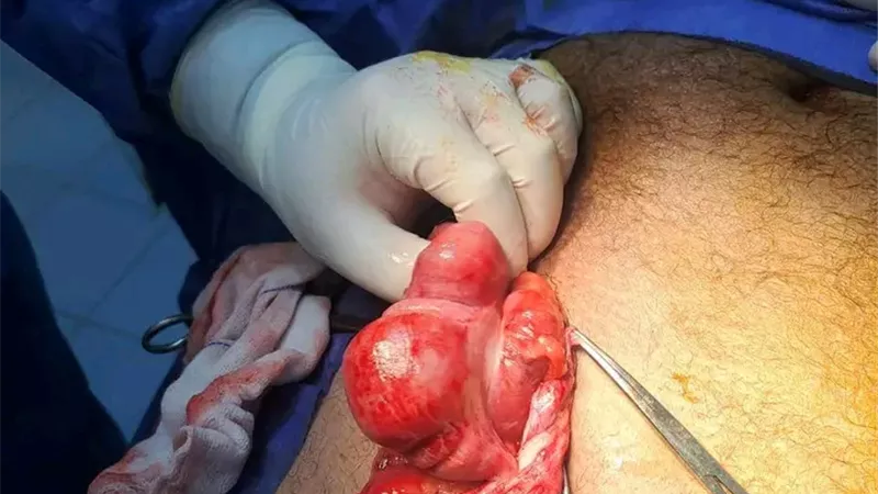 ‏صحة الدقهلية.. إنقاذ حياة مريض بفتق نادر خلال تدخل جراحي عاجل بمستشفى ميت سلسيل