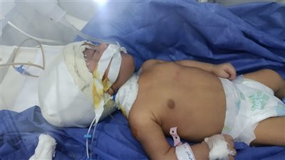 مستشفى طلخا المركزي ينجح فى تركيب صمام مخ خارجي لطفل عمره 35 يومًا